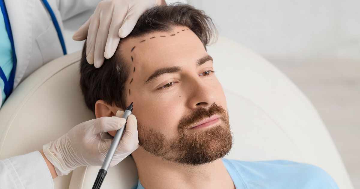 Transplante Capilar Goiânia: Solução Moderna para Queda de Cabelo