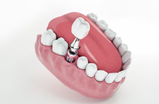 O Que Você Precisa Saber Sobre Implantes Dentários – Mitos e Verdades